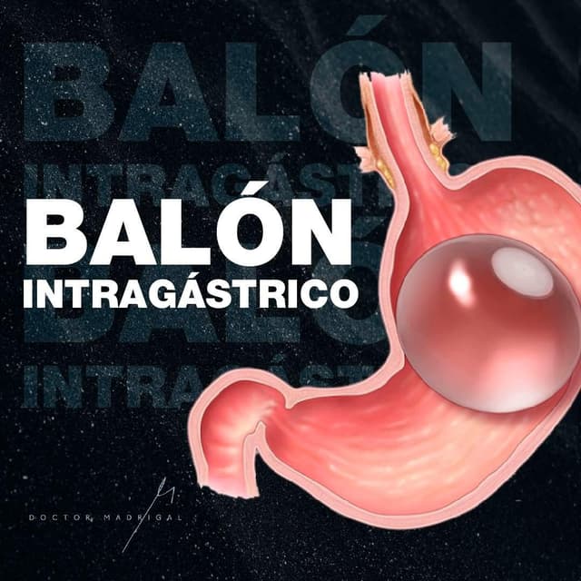 Balón Intragástrico